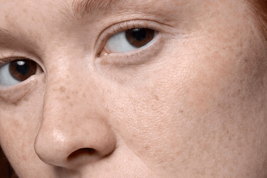 Tips untuk Mengatasi Masalah Kulit yang Sering Dialami Ibu Hamil: Hiperpigmentasi (Melasma)