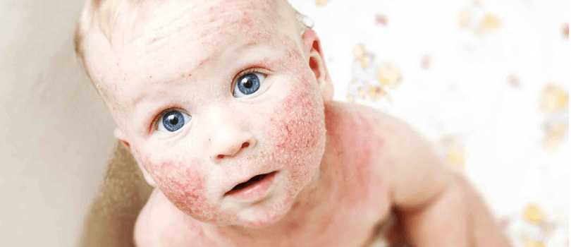 Macam-macam Dermatitis dan Gambarnya: Dermatitis Atopik