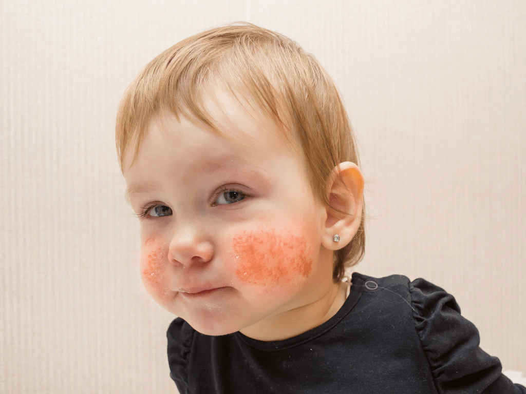 Dermatitis Perioral