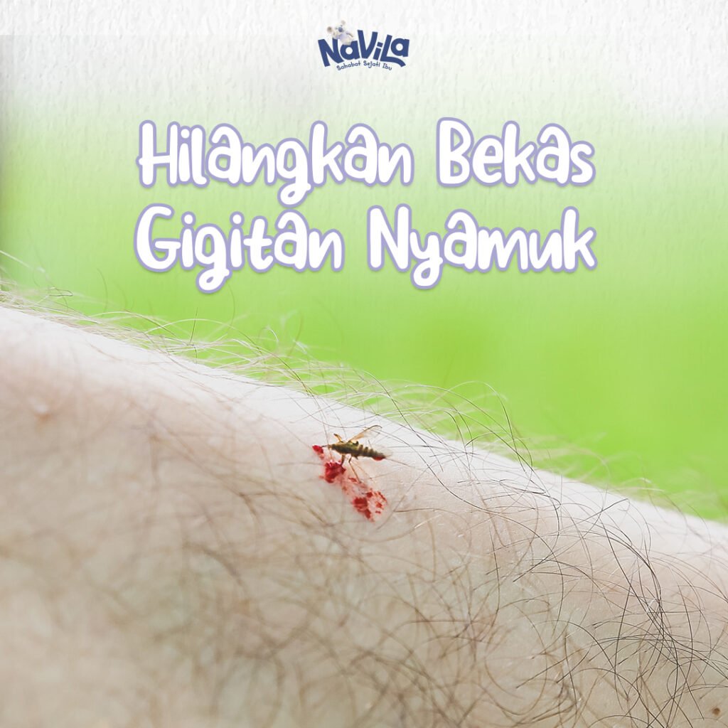 5 Cara Ampuh Menghilangkan Bekas Gigitan Nyamuk pada Bayi