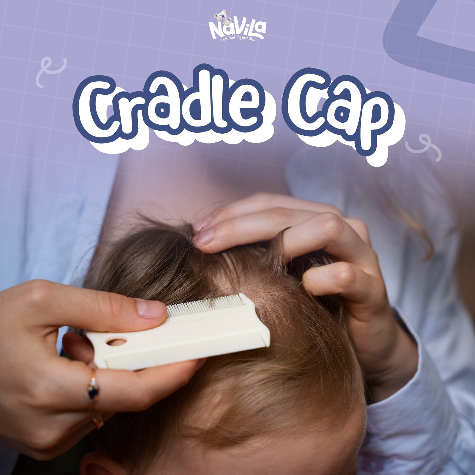 Cradle Cap Penyebab, Cara Mengatasi, dan Mitos yang Keliru