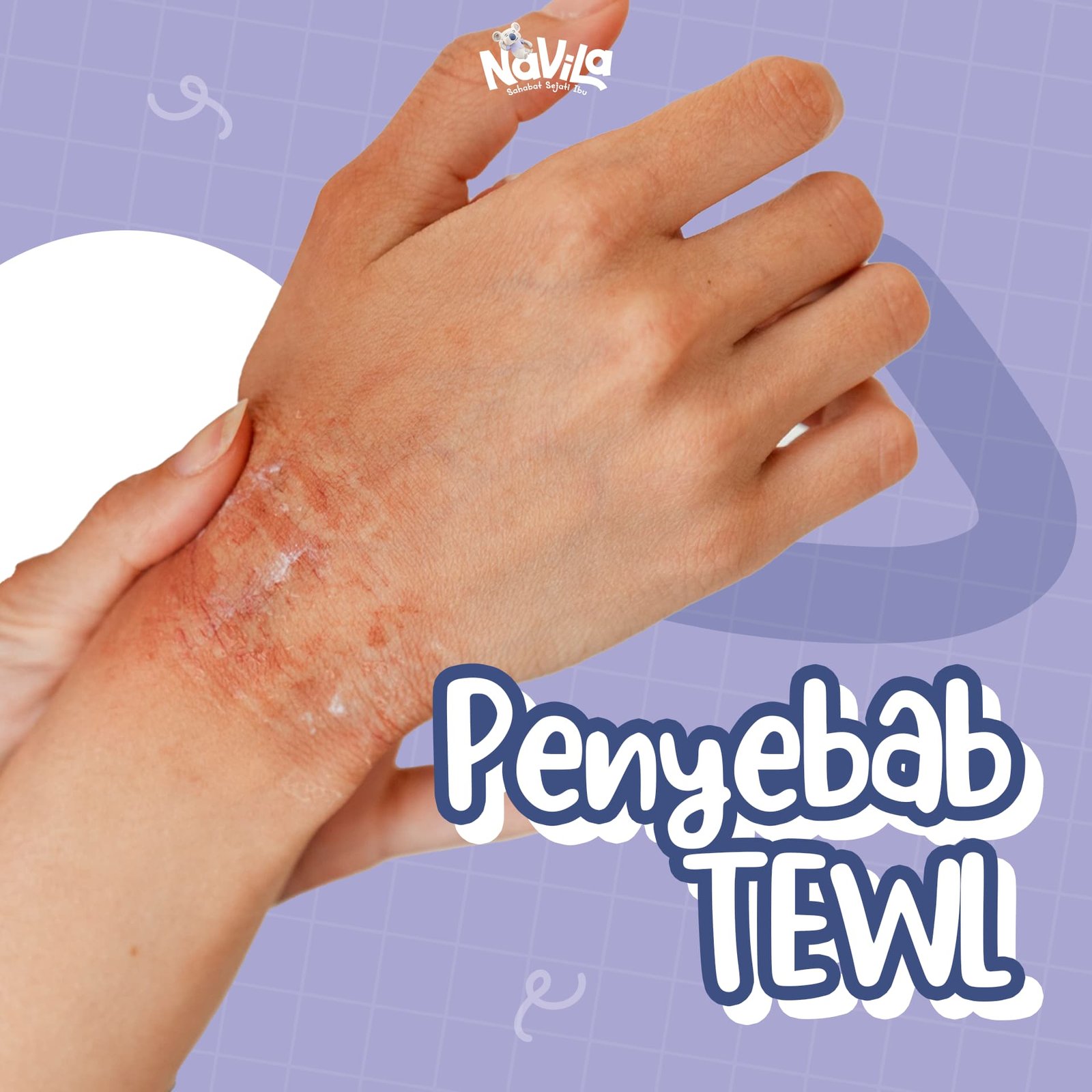 Penyebab TEWL Tinggi, Faktor yang Memicu Kehilangan Air Kulit