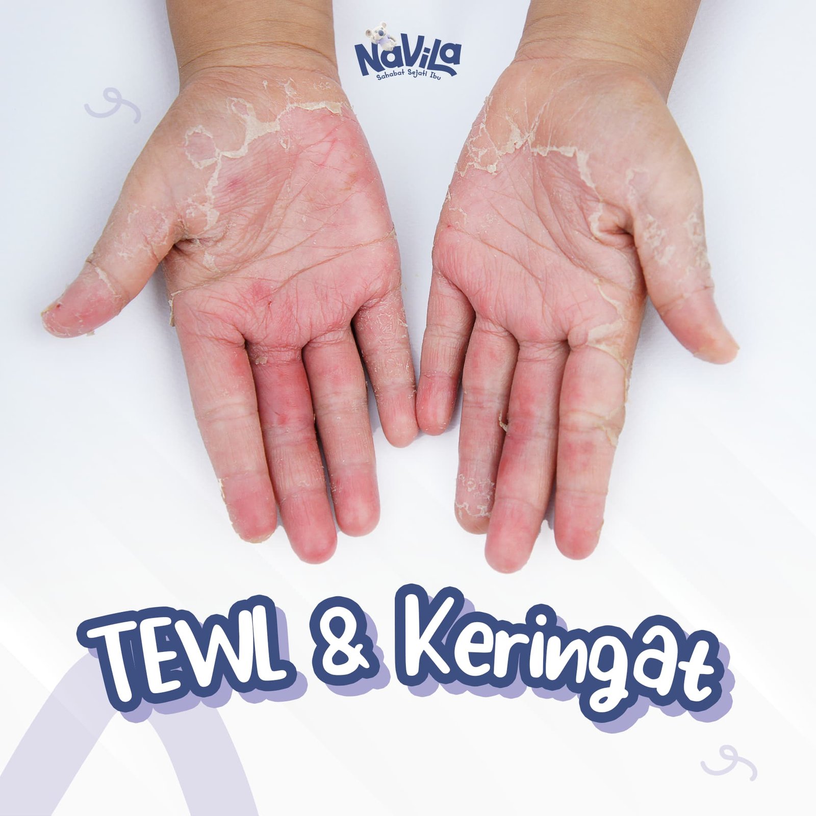 Perbedaan Kehilangan Air Transepidermal dan Keringat, Mana yang Perlu Diwaspadai