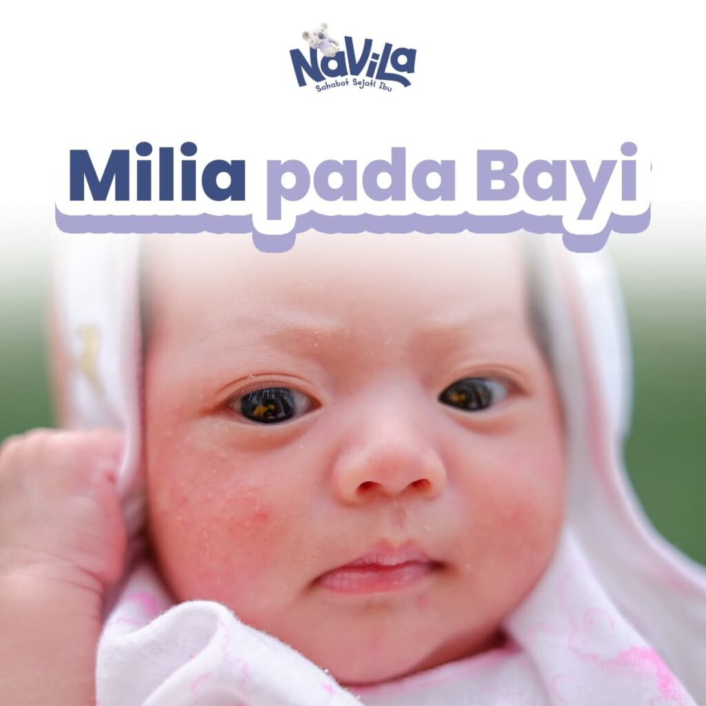 Apa Itu Milia pada Bayi Ciri, Penyebab, dan Cara Mengatasinya