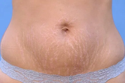 Warna Putih Keperakan (Striae Albae)
