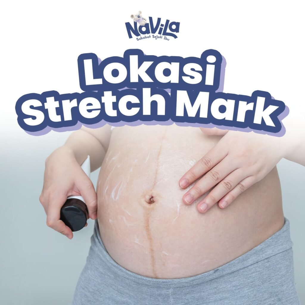 5 Lokasi Stretch Mark Paling Sering Muncul Saat Hamil Serta Tips Atasinya