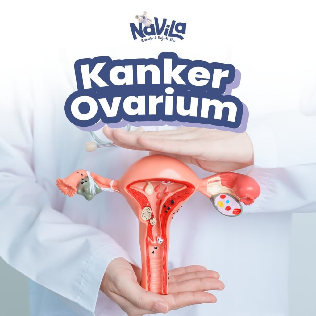 Kanker Ovarium Sering Terlambat Terdeteksi, Kenali Gejalanya Sejak Dini