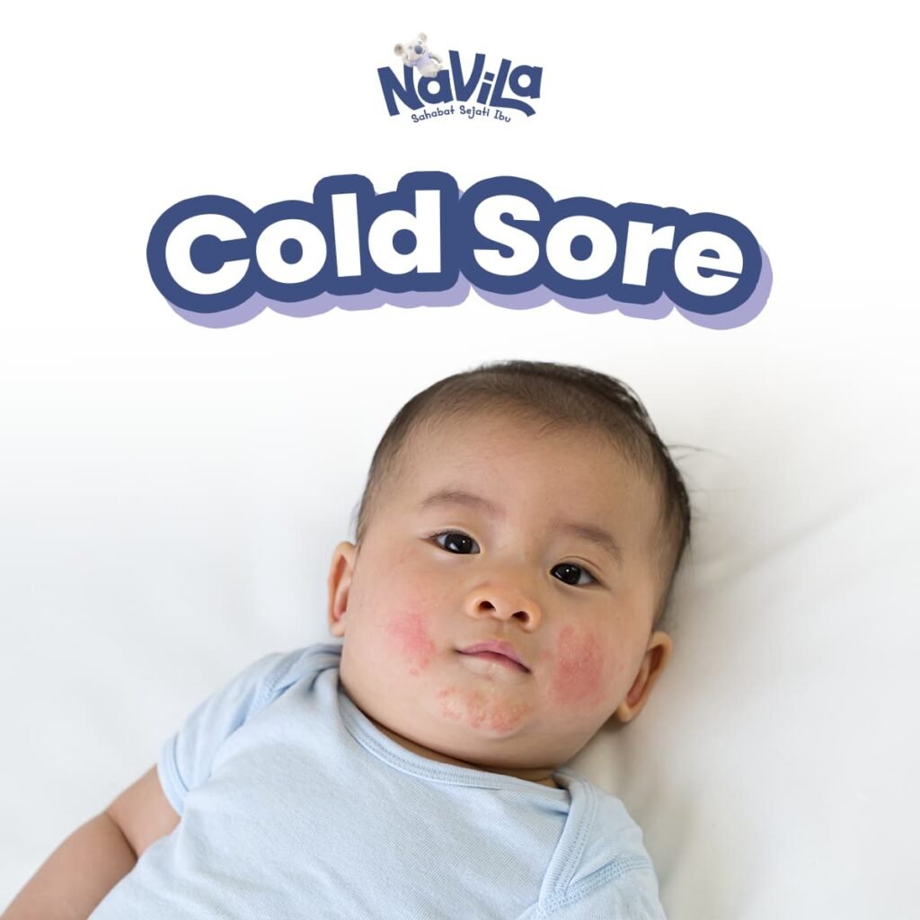 Muncul Luka di Bibir Bayi, Bisa Jadi Cold Sore! Ini Cara Atasinya