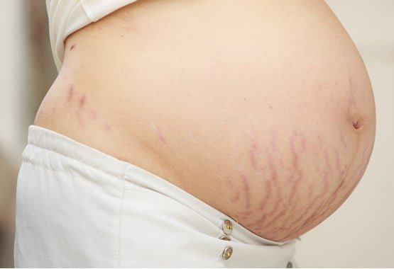 Stretch Mark Ibu Hamil di Perut (Bagian Bawah & Samping)