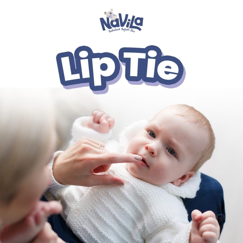 Susah Menyusu Mungkin Karena Lip Tie, Mams! Ini Tanda-Tandanya