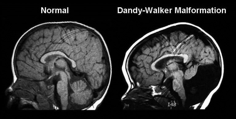 Dandy Walker Syndrome Adalah Gangguan Otak Belakang Sejak Janin