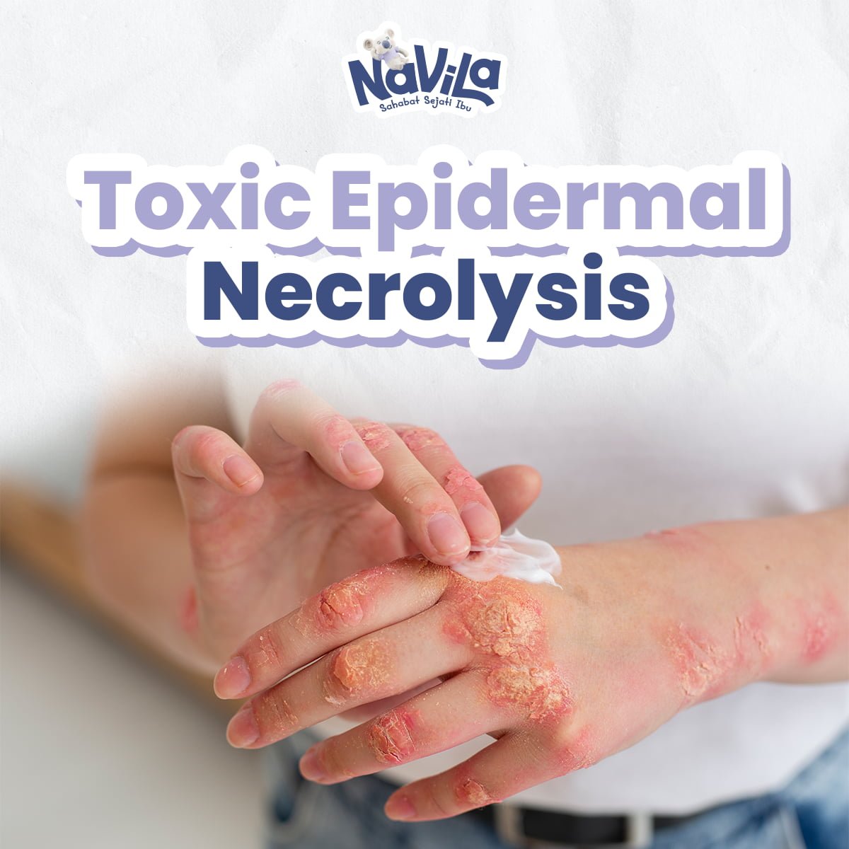Penyebab Toxic Epidermal Necrolysis serta Penanganannya