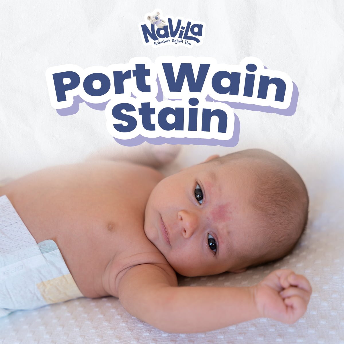 Tanda Lahir yang Tidak Normal, Kenali Port Wine Stain