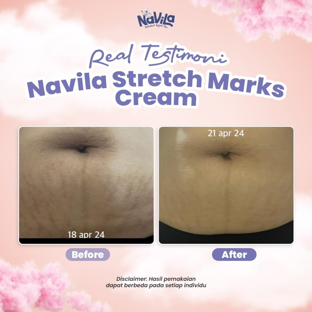 Testi Navila Stretch Mark Cream