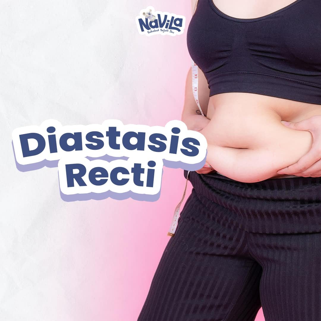 Diastasis Recti pada Ibu Pascapersalinan dan Cara Mengembalikan Kekuatan Otot Perut