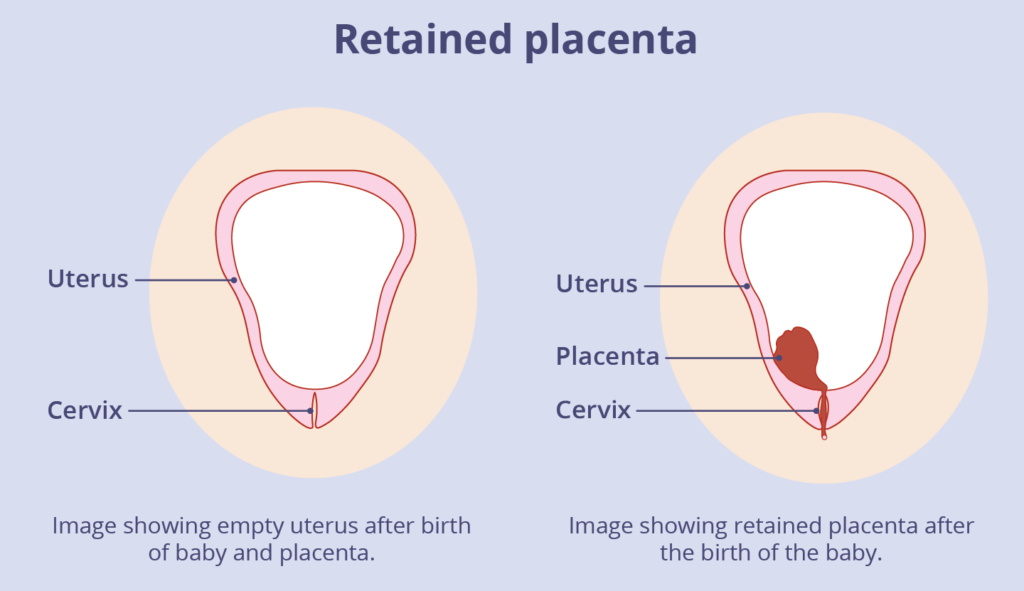 Retained Placenta
