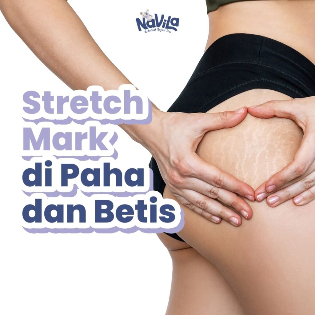 Cara Menghilangkan Stretch Mark di Betisa dan Paha Secara Alami dan Cepat