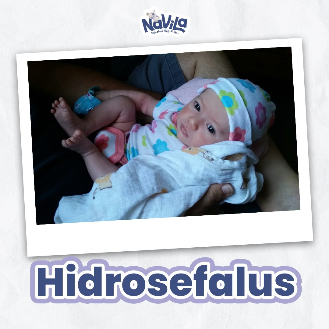 Mengenal Hidrosefalus pada Bayi dan Tanda yang Harus Diwaspadai Sejak Dini