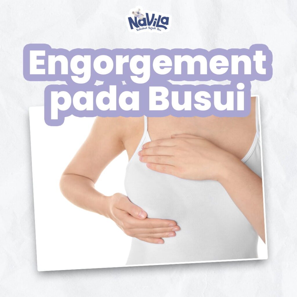 Mengenal Engorgement atau Payudara Bengkak di Awal Menyusui, Apa Solusinya